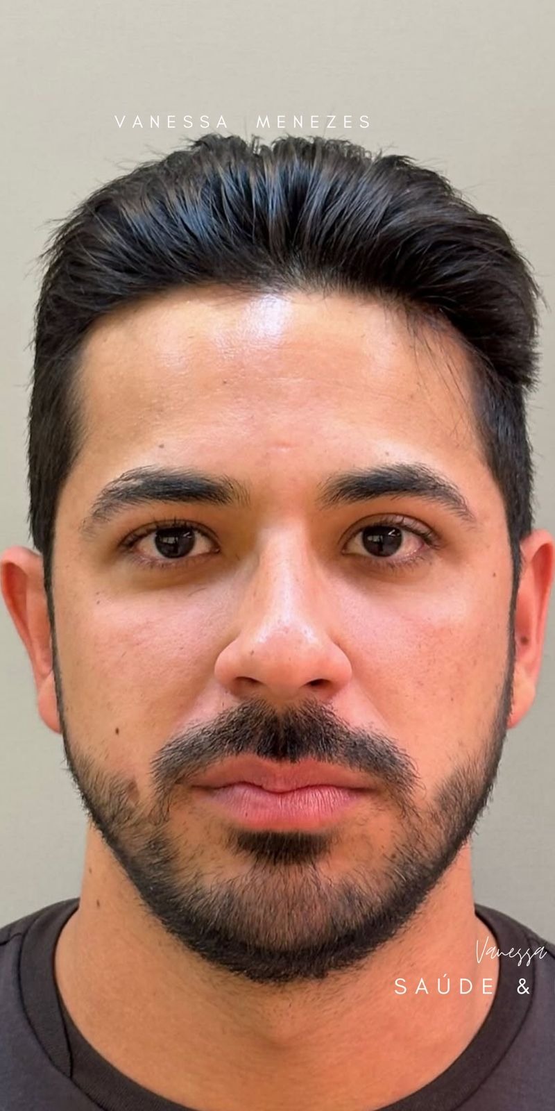 Antes — Harmonização Facial