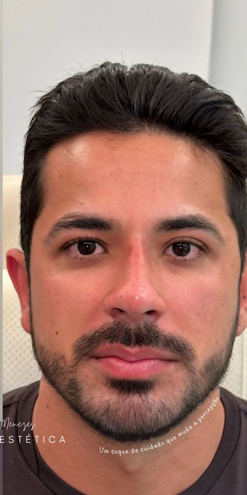 Depois — Harmonização Facial