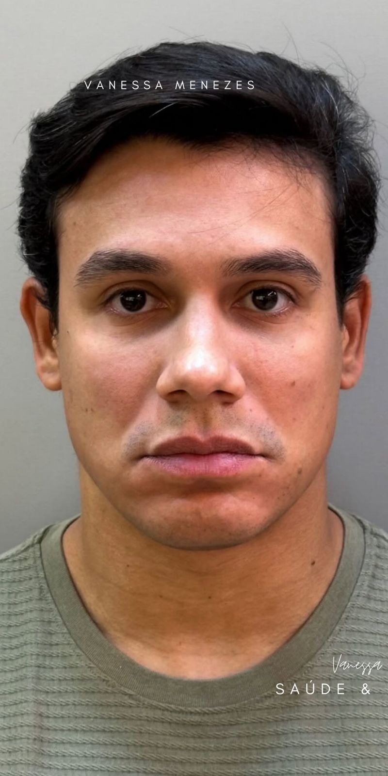 Antes — Harmonização Facial