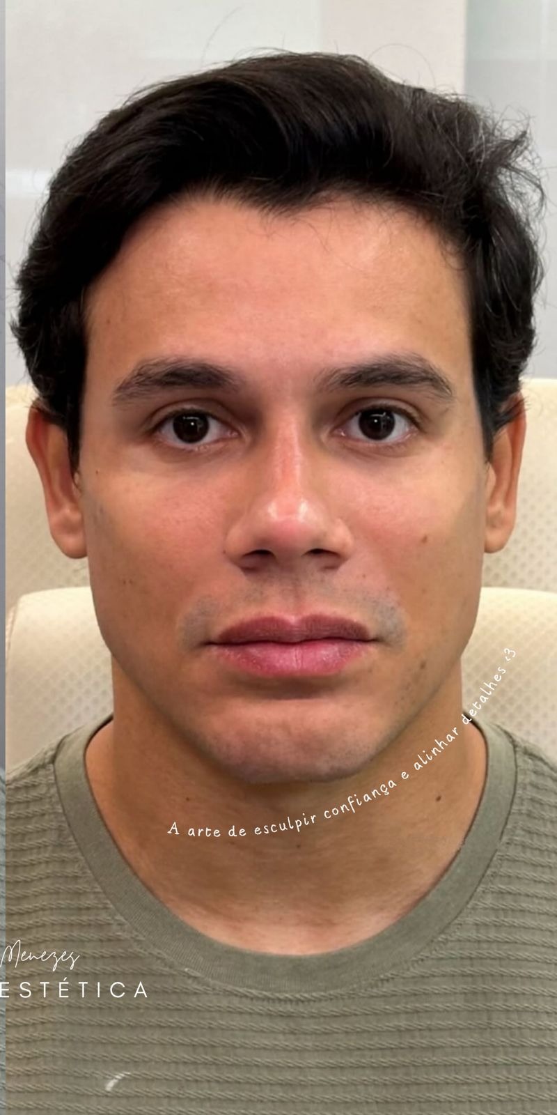 Depois — Harmonização Facial