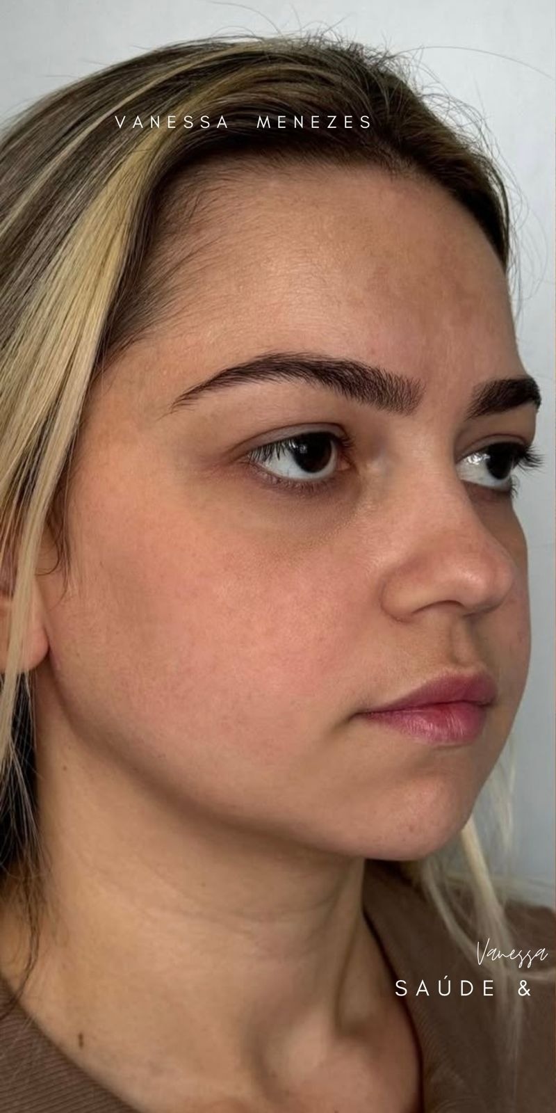 Antes — Harmonização Facial