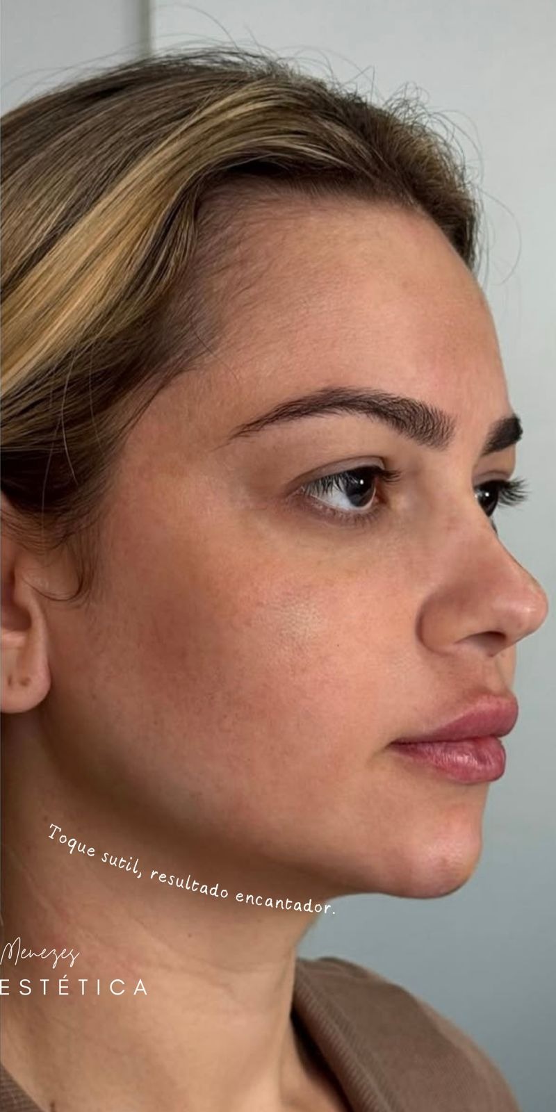 Depois — Harmonização Facial