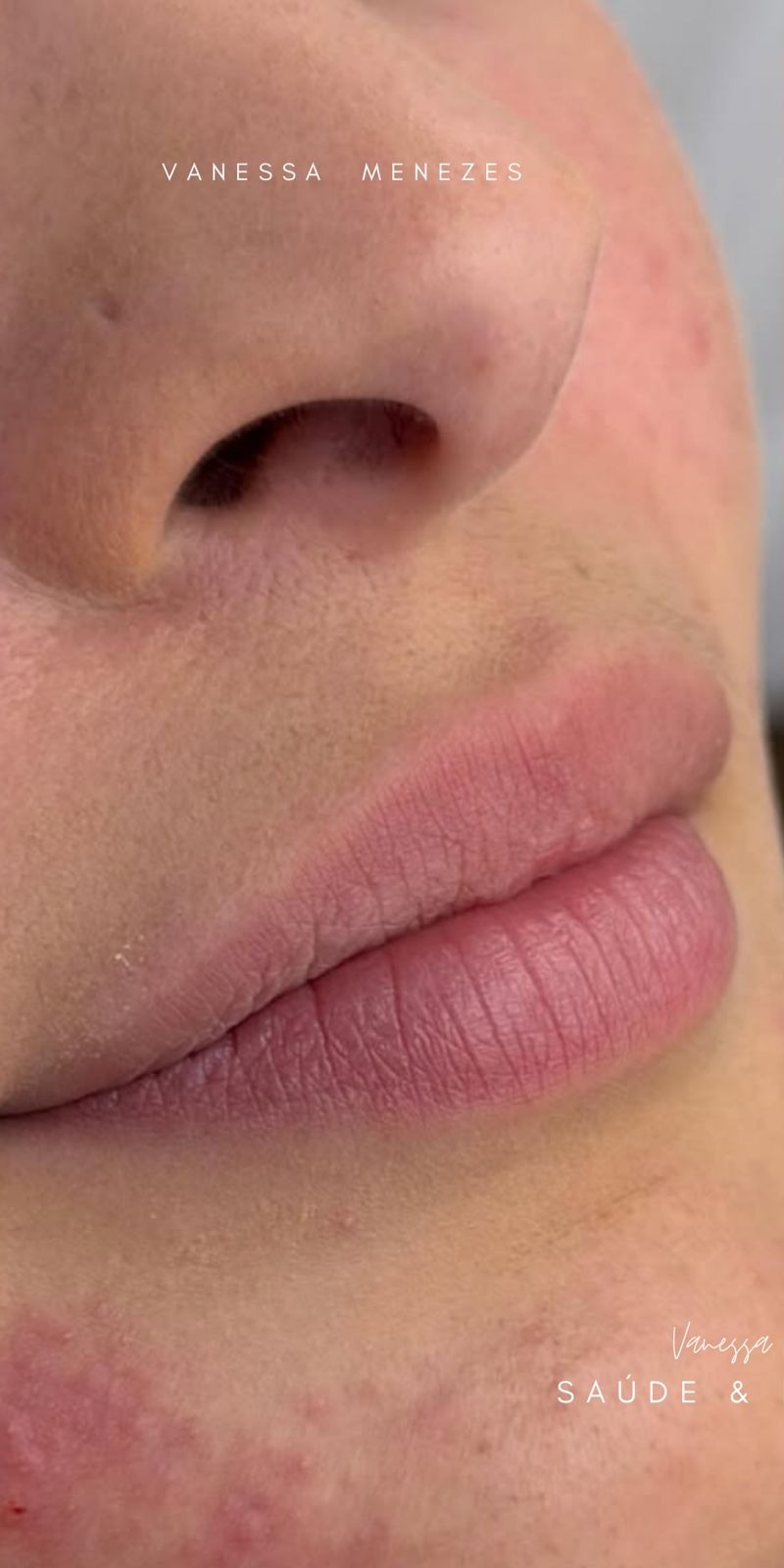 Antes — Definição Labial
