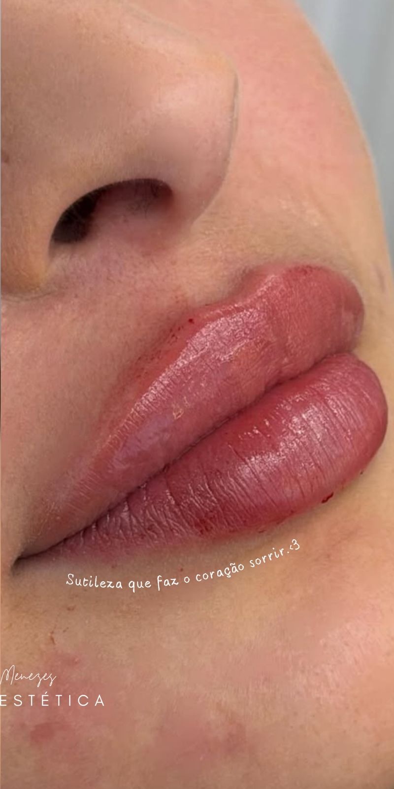 Depois — Definição Labial