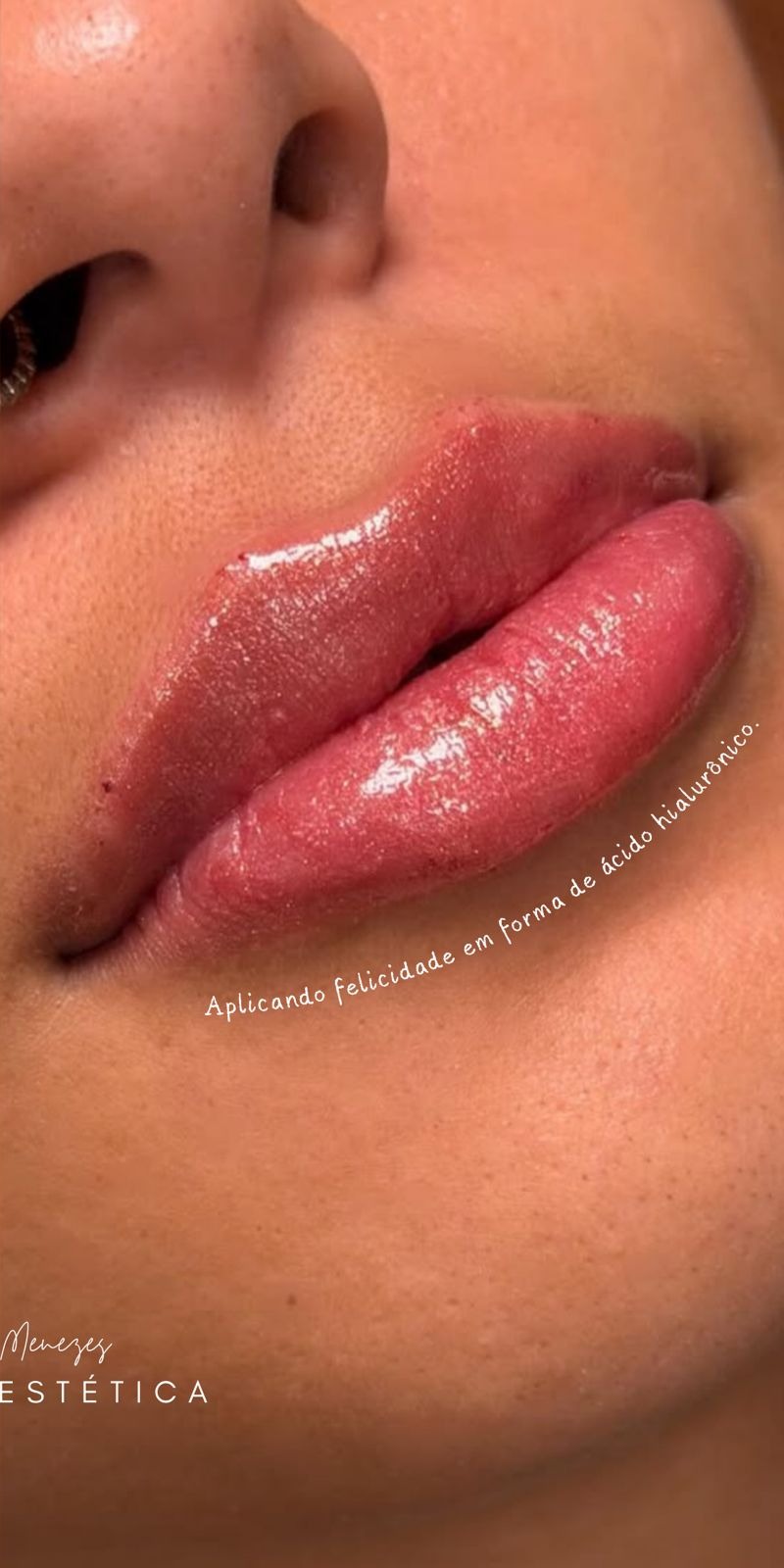 Depois — Definição Labial