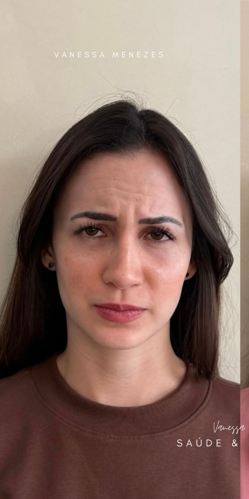 Antes — Toxina Botulínica