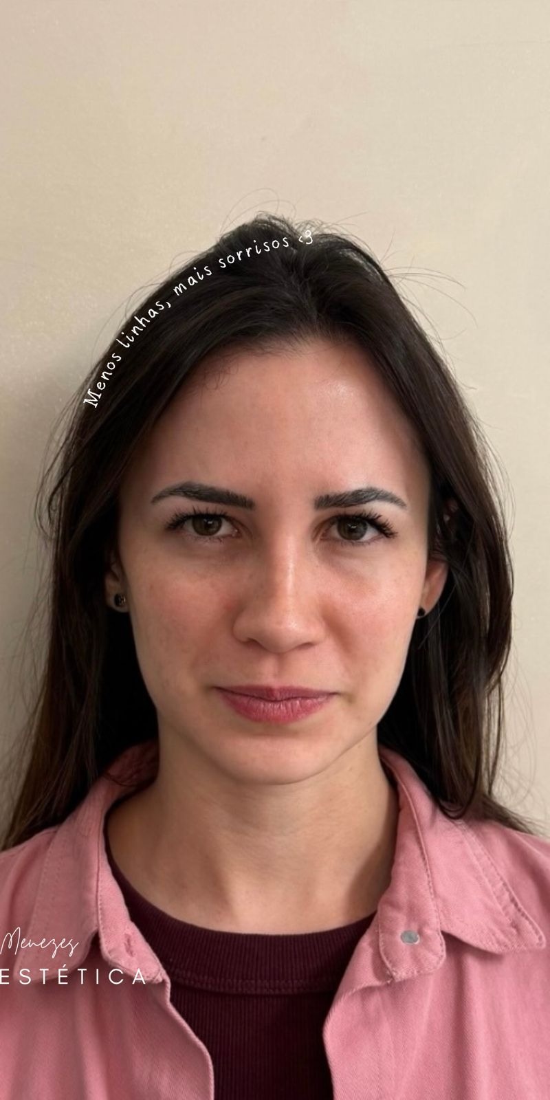 Depois — Toxina Botulínica
